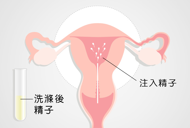 人工受精-嘉安试管婴儿中心,不孕症,试管婴儿,人工受孕,冷冻卵子