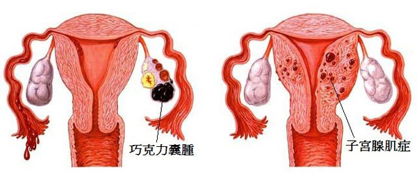 巧克力囊肿、子宫腺肌症